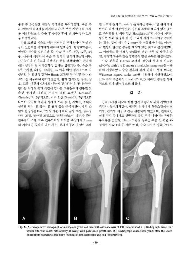 박윤수 등, COREN Hip system을 이용한 무시멘트 고관절 전치환술, 대한고관절학회지, 2007 - page 3
