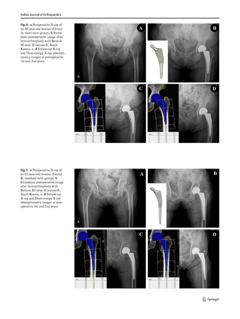 JY Lim et al, Comparison of Bone Preservation in Elderly Patients with Femoral_, Indian Journal of Orthopaedics, 2020 - page 9