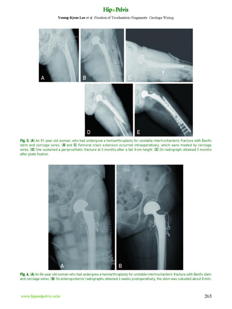 YK Lee et al., Fixation of Trochanteric Fragments in Cementless Bipolar Hemiarthroplasty of Unstable Intertrochanteric - page 4
