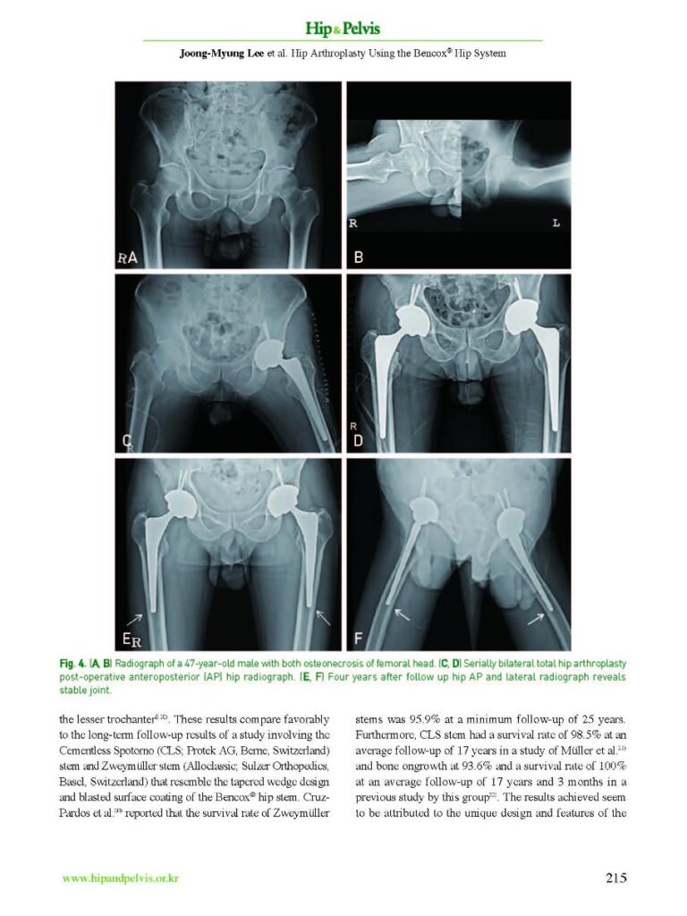 JM Lee et al., Hip Arthroplasty Using the Bencox Hip System 1000 cases, Hip&Pelvis, 2018 - page 6