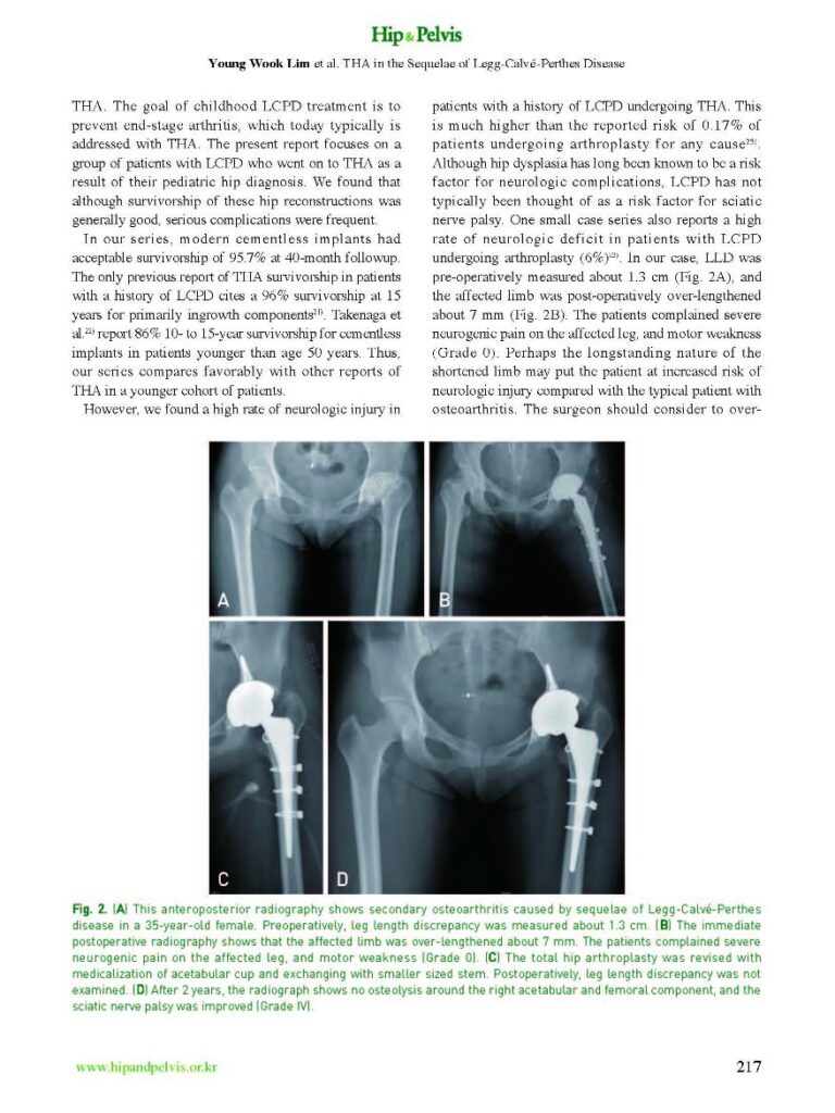 YW Lim et al., THA in Patient with the Sequelae of Legg-Calve-Perthes Disease, Hip&Pelvis, 2014 - page 4