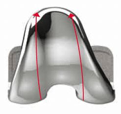 Exult Knee Lateralized anterior trochlea groove